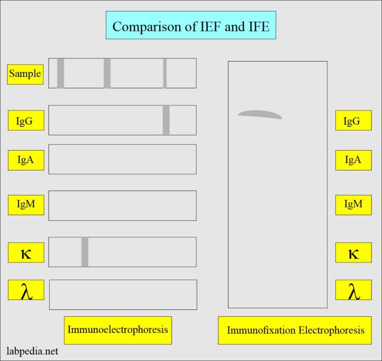 Monoclonal Immunoglobulin Ig Monoclonal Antibody Immunofixation