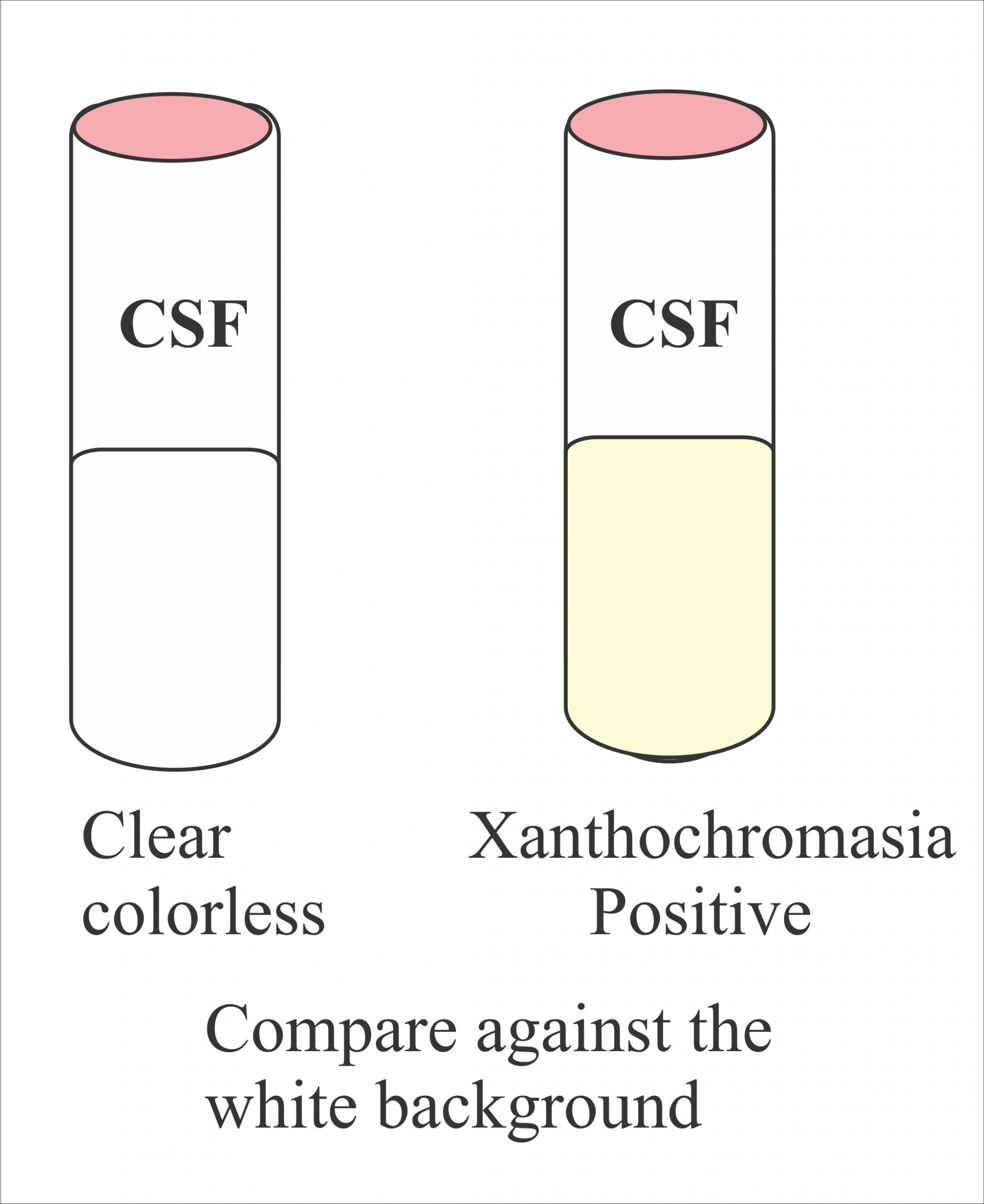 Cerebrospinal Fluid Analysis Part 2 Csf Complete Examination Normal Abnormal Labpedia Net