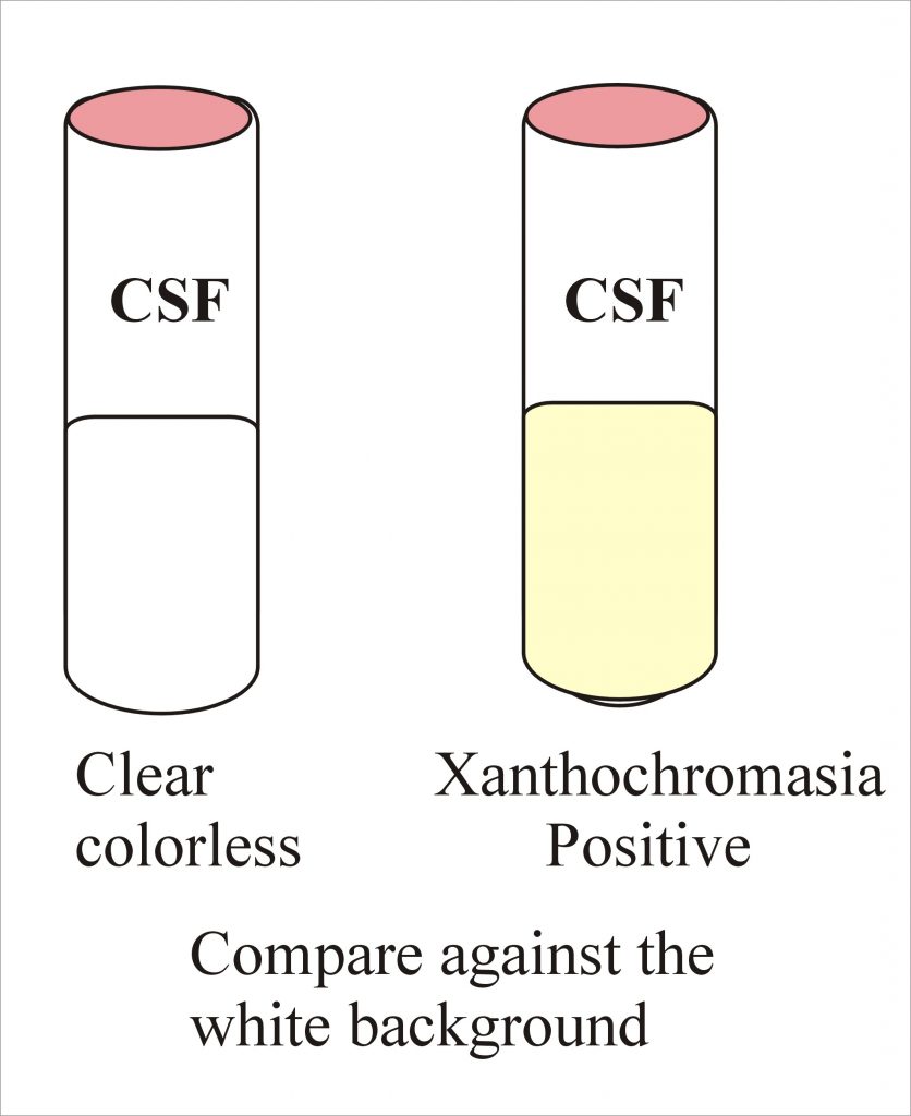 Cerebrospinal fluid Xanthochromia , (CSF)