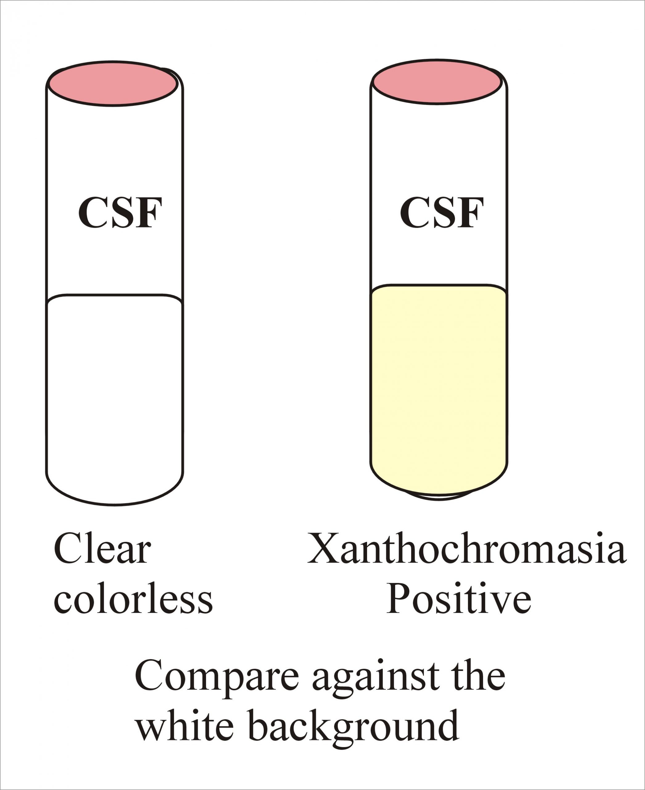 Cerebrospinal Fluid Xanthochromia Csf