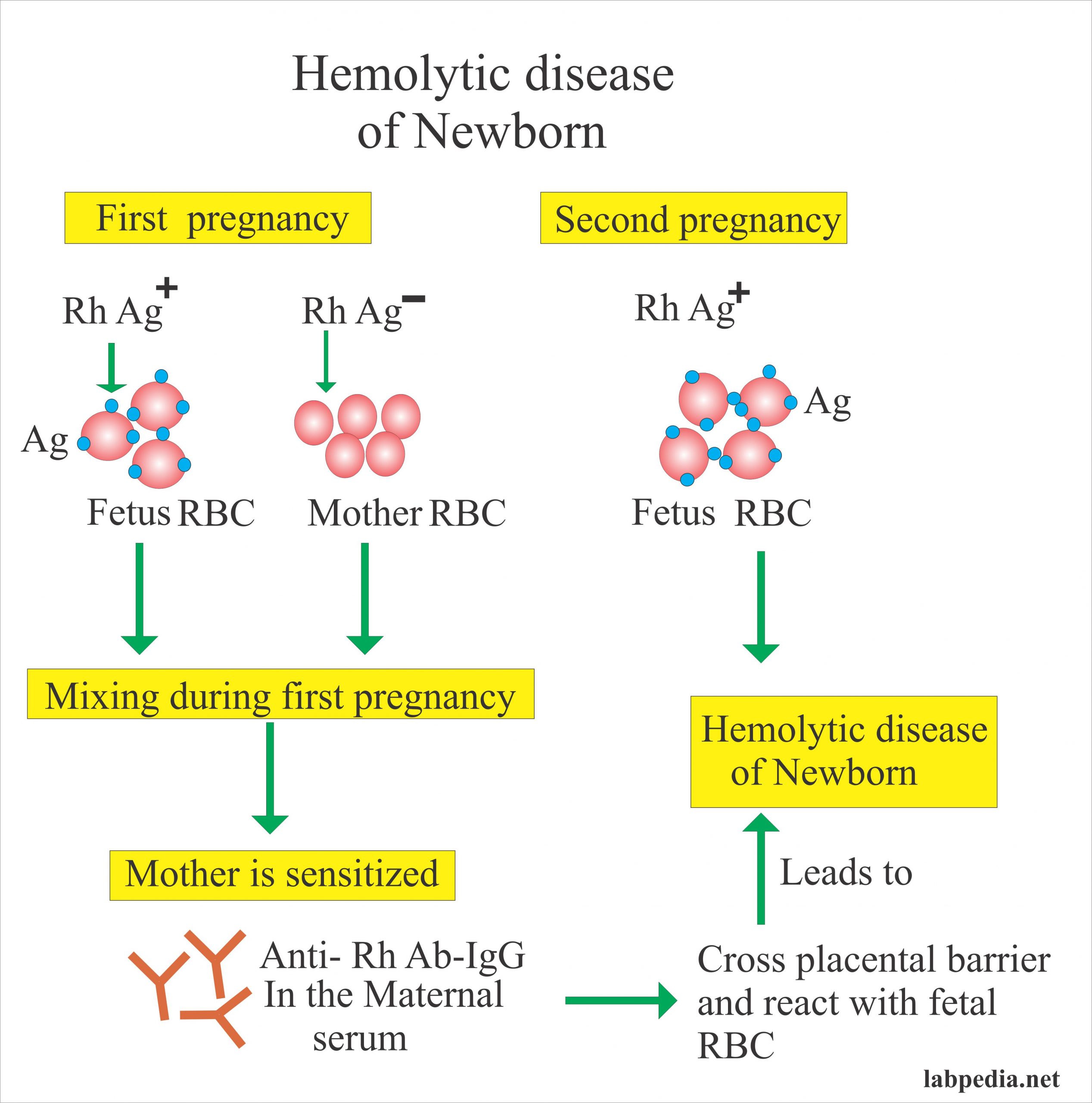 Coombs Test Part 3 Hemolytic Anemia Of Newborn Rh Antibody Anti D Antibody Labpedia Net