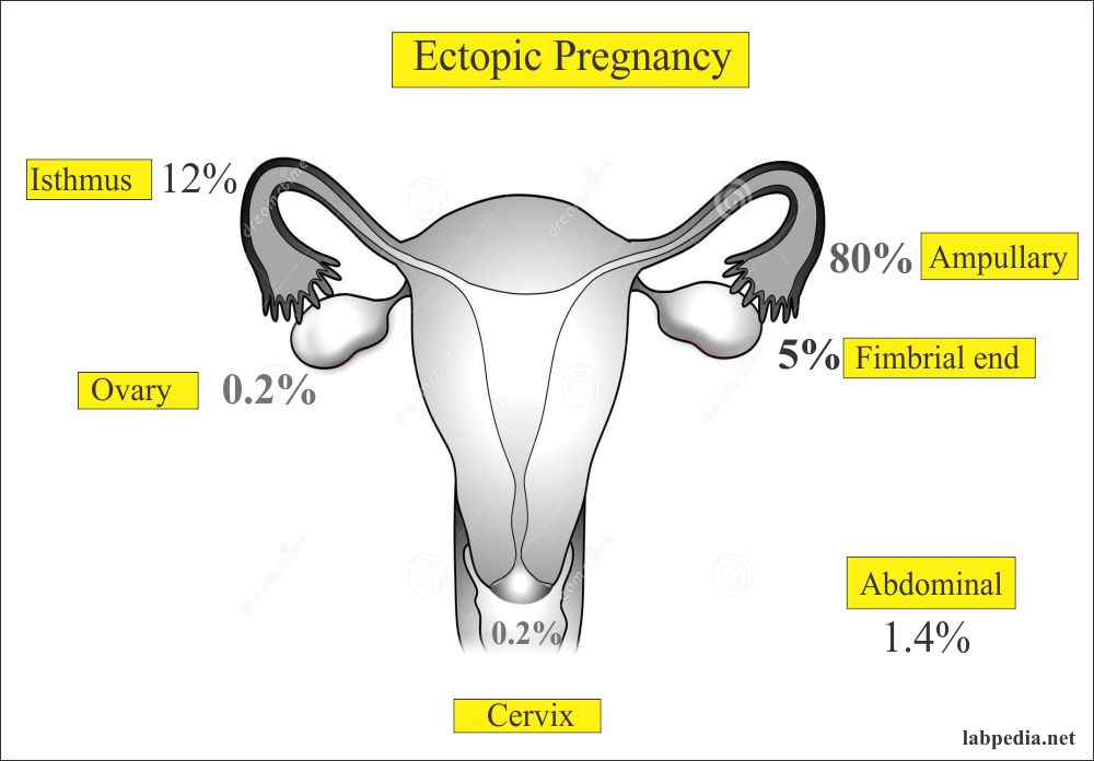 Ectopic Pregnancy And Its Diagnosis Labpedia