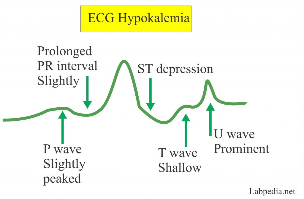 Electrolytes Part 1 Potassium K Blood Labpedia Net