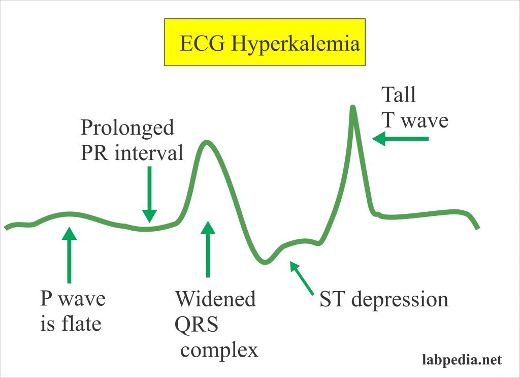 Electrolytes Part 4 Sodium And Potassium Na And K Ecg Changes Labpedia Net