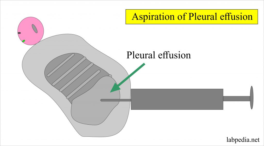 Fluid Analysis – part 6 – Pleural Fluid Analysis, Aspiration procedure, Thoracentesis