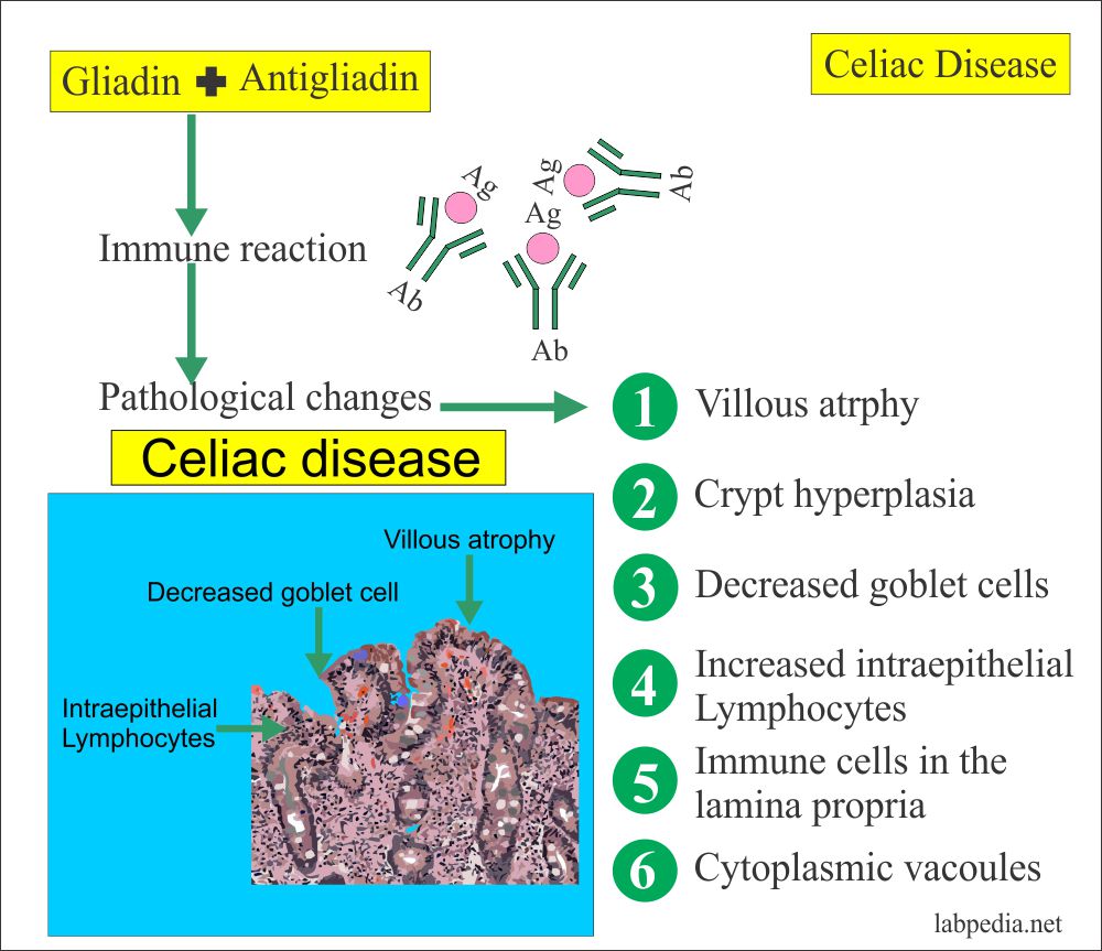 Gliadin Antibodies IgA, IgG (Endomysial Antibodies) Celiac disease and