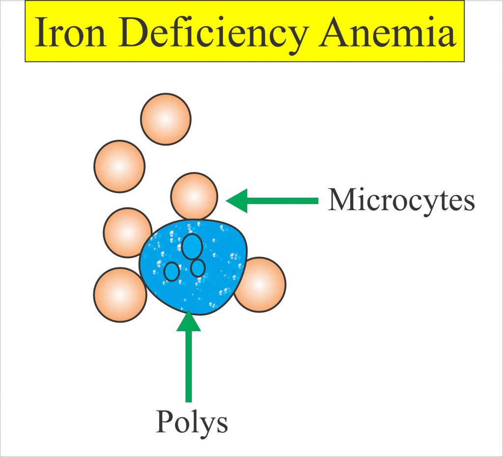 Anemia Part 3 Iron Deficiency Anemia Microcytic And Hypochromic