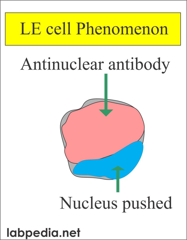 LE cell phenomenon (Lupus erythematosus cell)