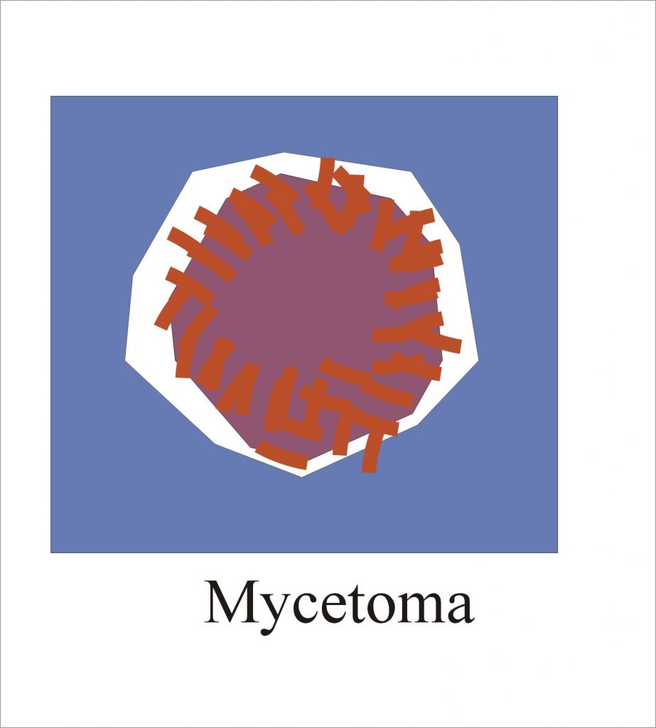 Mycetoma Diagnosis and Causative Agents