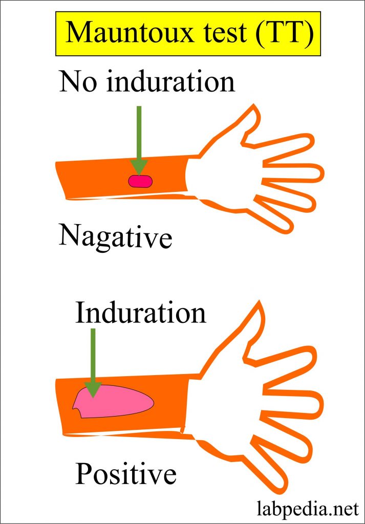 difference-between-positive-tb-skin-test-and-negative-tb-skin-test