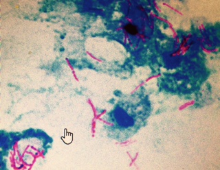 Mycobacterium Tuberculosis:- Part 3 – Acid-Fast Bacilli Culture (AFB Culture)