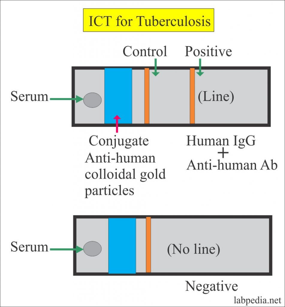 Mycobacterium Tuberculosis:- Part 7 – Tuberculosis Test by ICT (Immunochromatography technique)