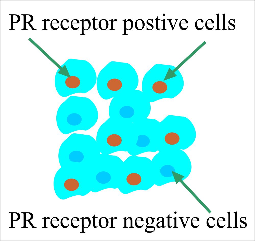 PR receptor positive