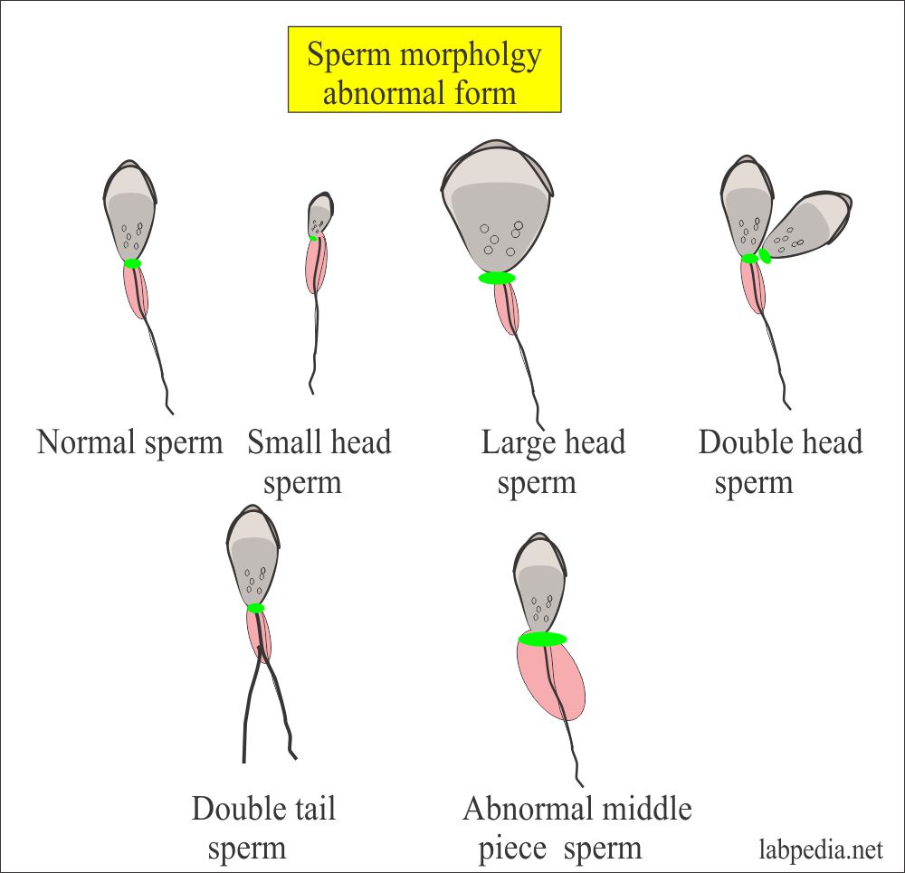 sperm abnormal forms