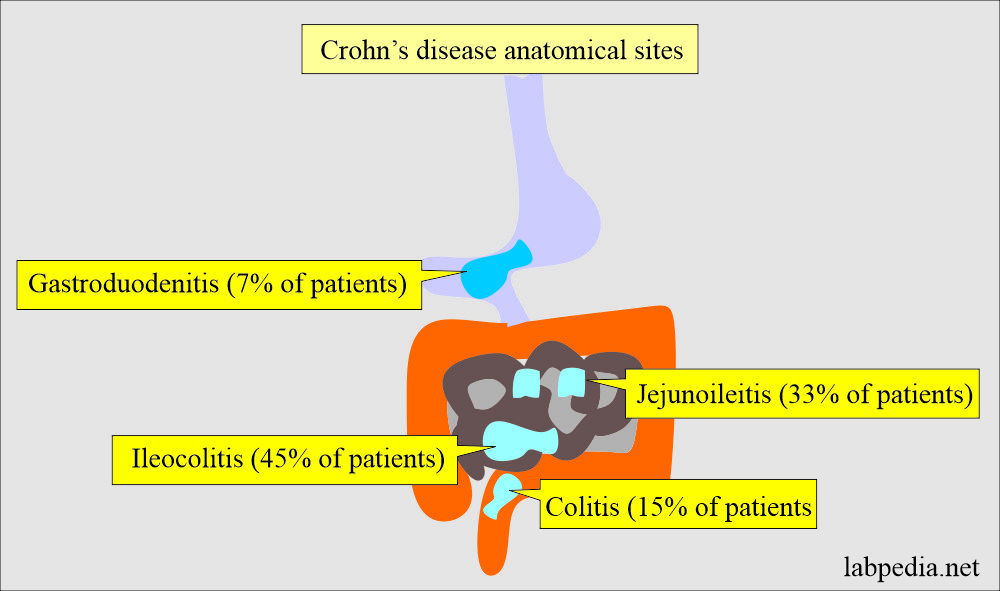 Crohn's disease anatomical sites