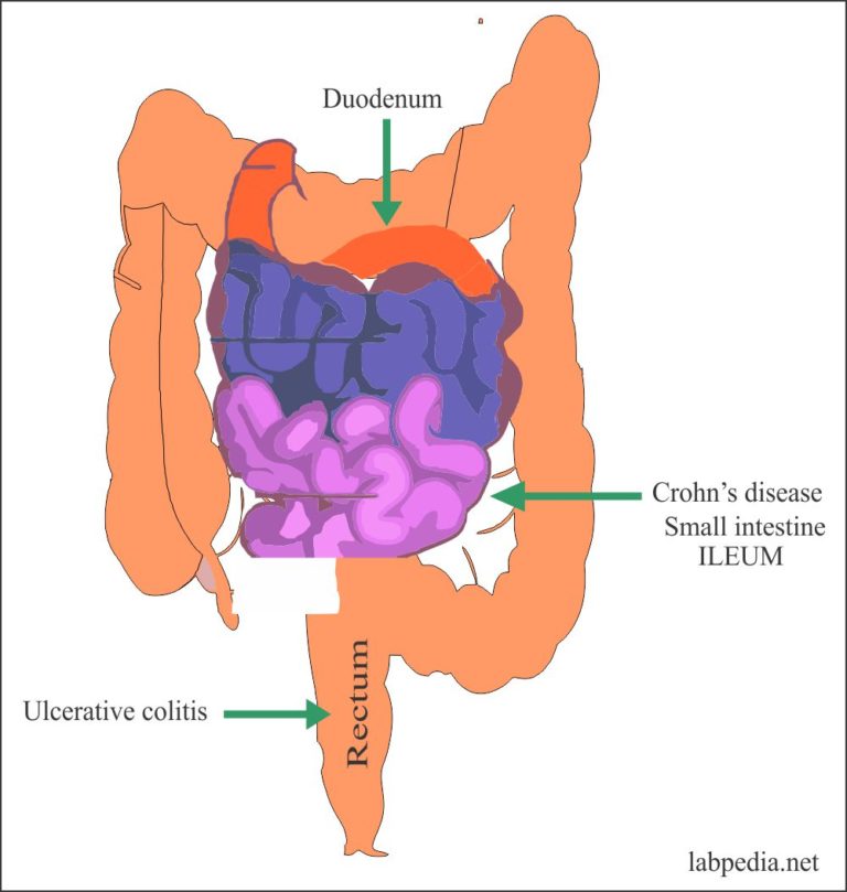 Ulcerative Colitis And Crohn's Disease - Labpedia.net