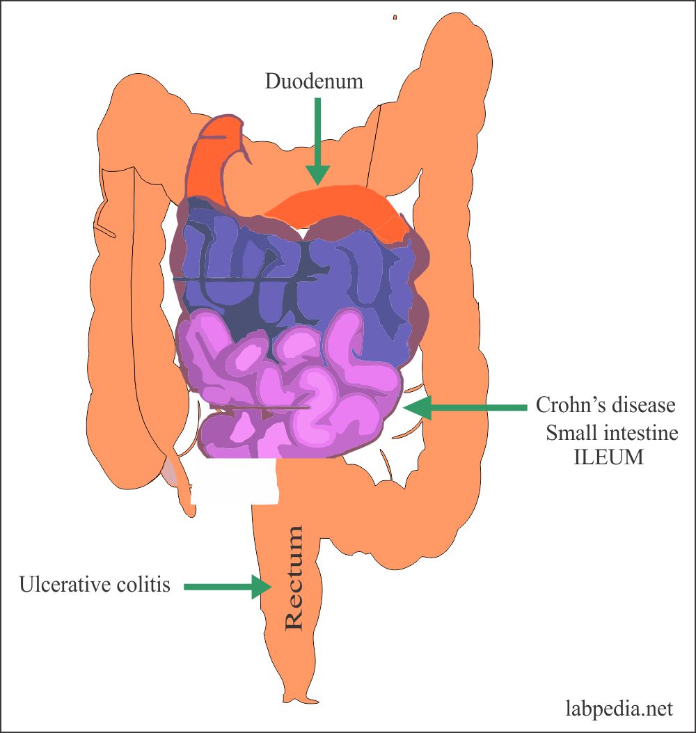 ulcerative and crohn's disease