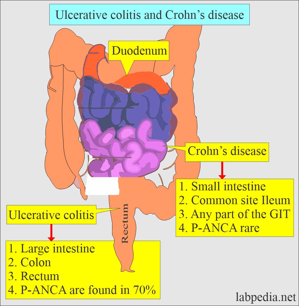 Ulcerative colitis features