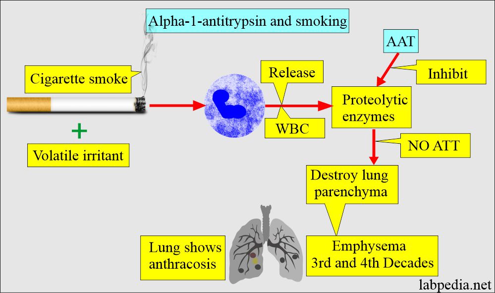 Alpha-1-antitrypsin (AAT) and cigarette smoking leads to emphysema
