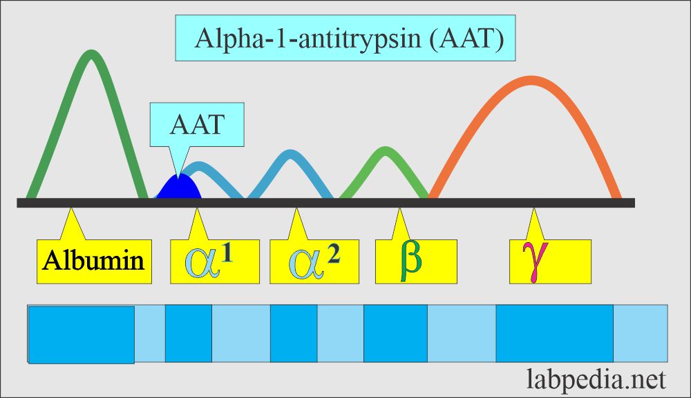 alpha-1-antitrypsin (AAT) electrophoresis