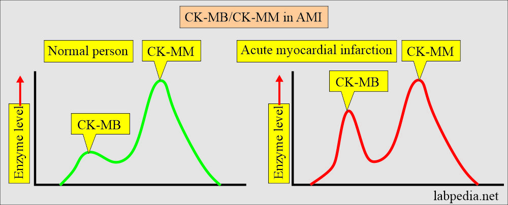 AMI showing CK-MB and CK-MM pattern