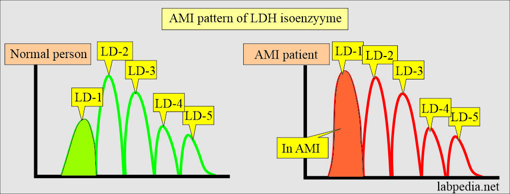 Changes in Acute myocardial infarction (AMI) of lactate dehydrogenase (LDH)