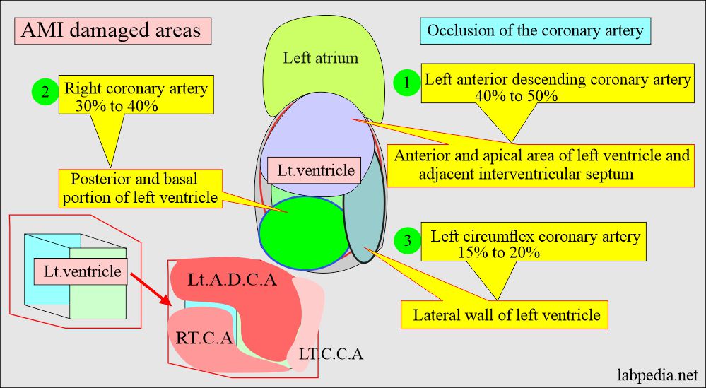 AMI damaged areas due to occlusion of the coronary arteries