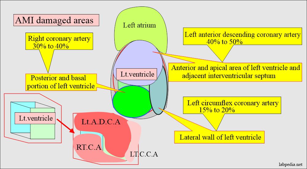 AMI, damage of the muscles according to involvement of coronary artery