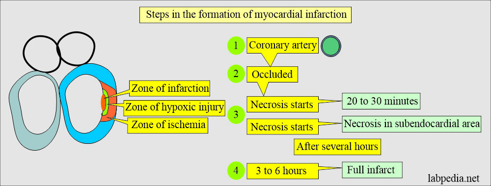 AMI stages for acute myocardial infarction