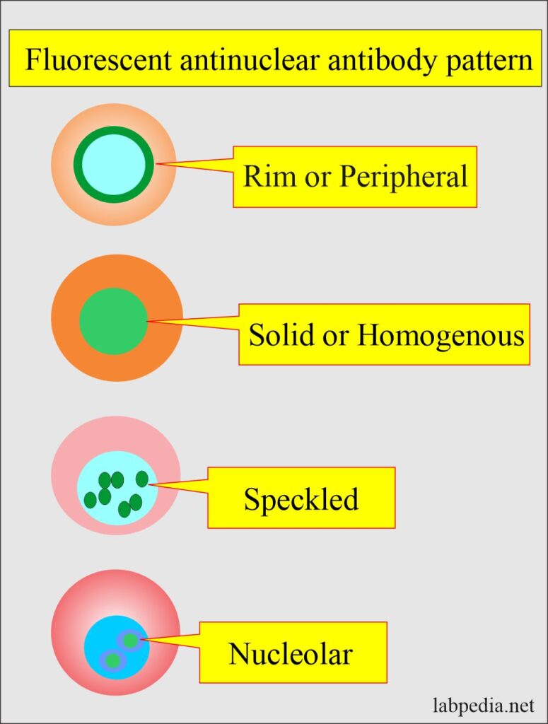 Anti-DNA, (anti-double-stranded DNA antibodies, Anti-ds-DNA Ab) and