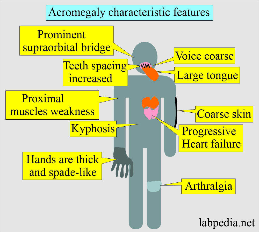 Acromegaly characteristic features