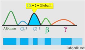 Serum Protein Electrophoresis, Total protein, albumin and globulin ...