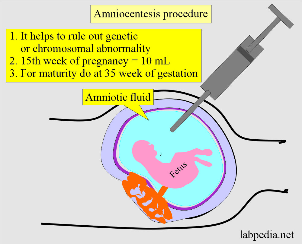 Amniocentesis procedure