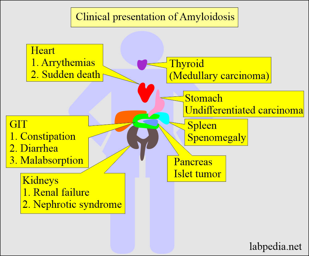 Clinical presentation of Amyloidosis