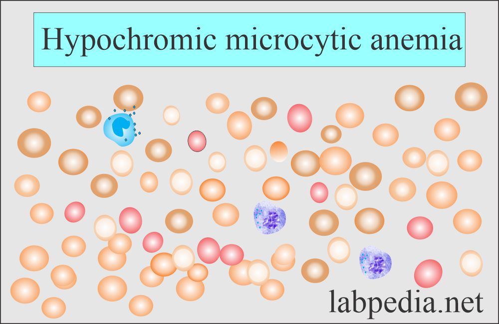 Mean corpuscular volume (MCV): Anemia hypochromic microcytic