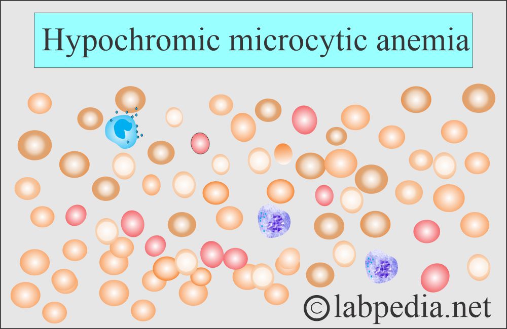 Anemia hypochromic microcytic Anemia hypochromic microcytic