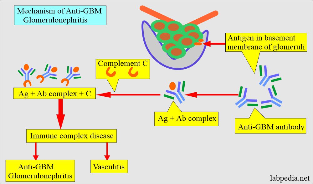 Anti-GBM glomerulonephritis