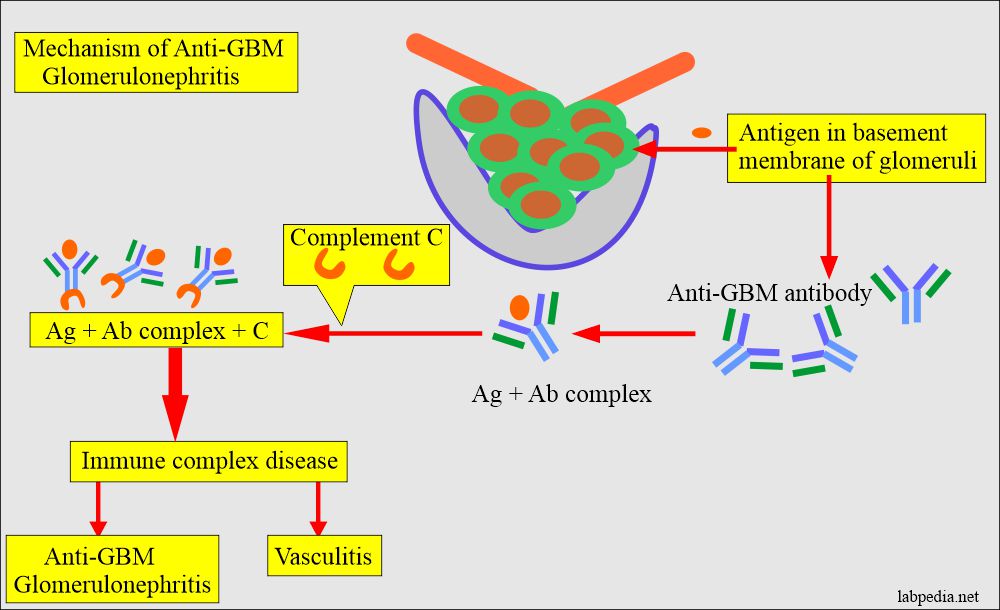 Anti-Glomerular basement membrane antibody (Anti-GBM antibody)