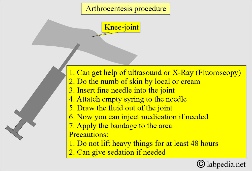 Arthrocentesis procedure Arthrocentesis procedure