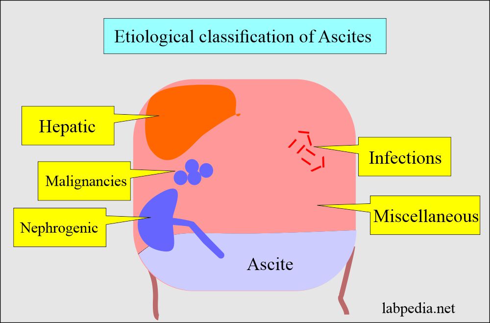Ascites etiological classification