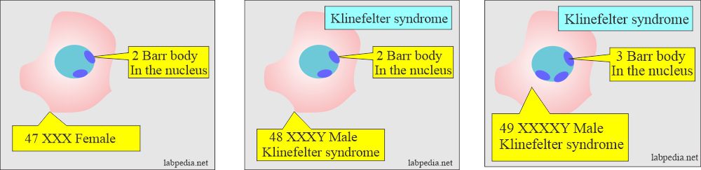 Barr bodies pattern in female and Klinefelter syndrome