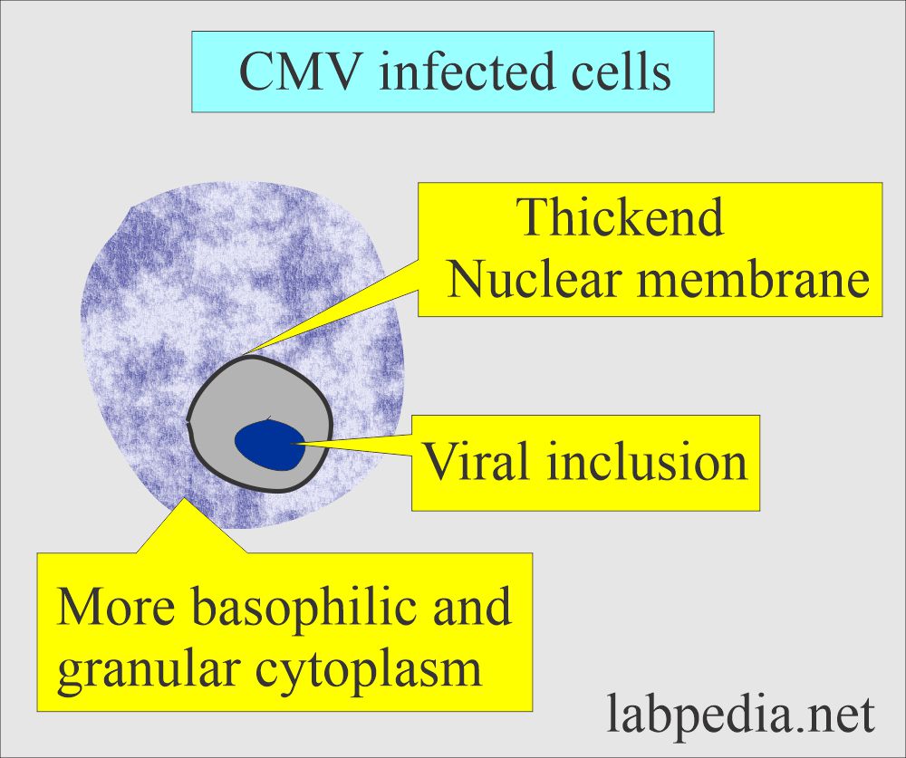 CMV inclusion body