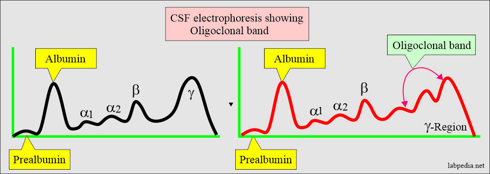 Cerebrospinal Fluid Analysis: CSF electrophoresis showing oligoclonal band