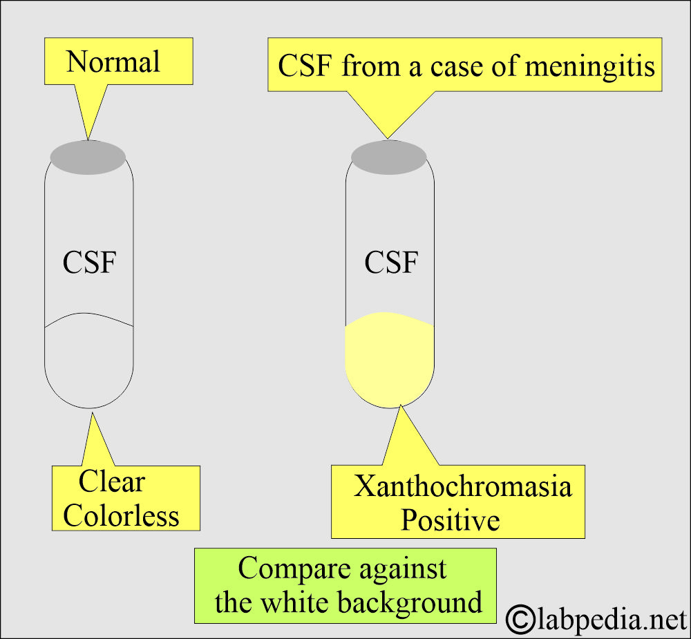 CSF xanthochromasia