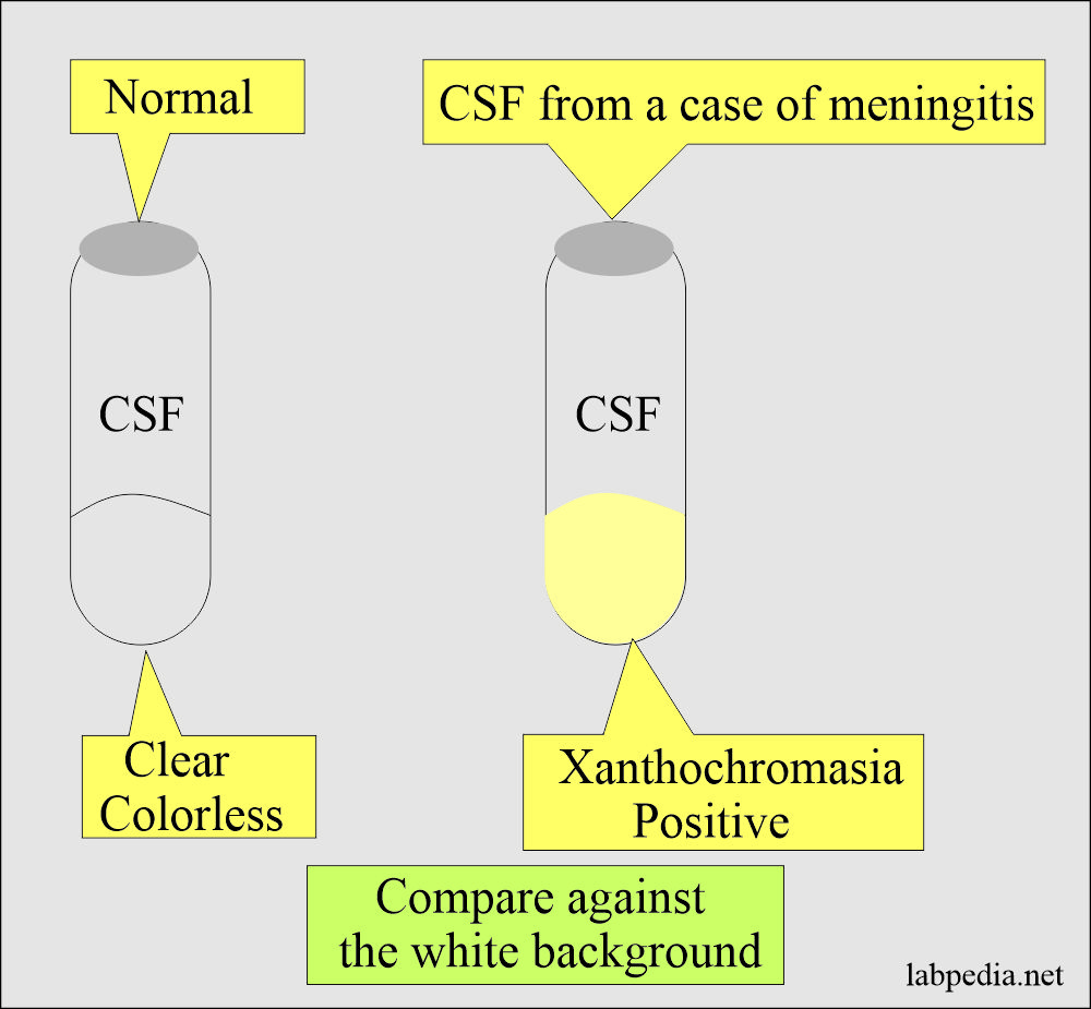 Cerebrospinal fluid Xanthochromia: CSF Xanthochromia