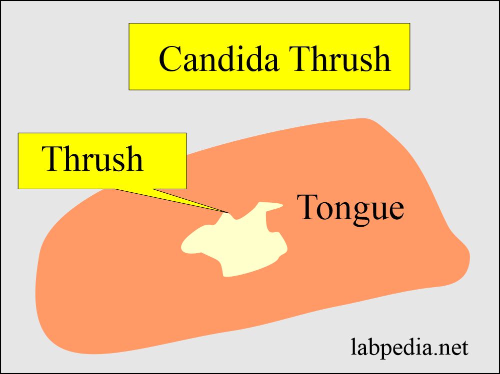 Candida leading to thrush