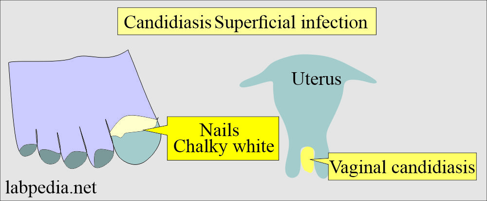 Candidiasis, superficial infection
