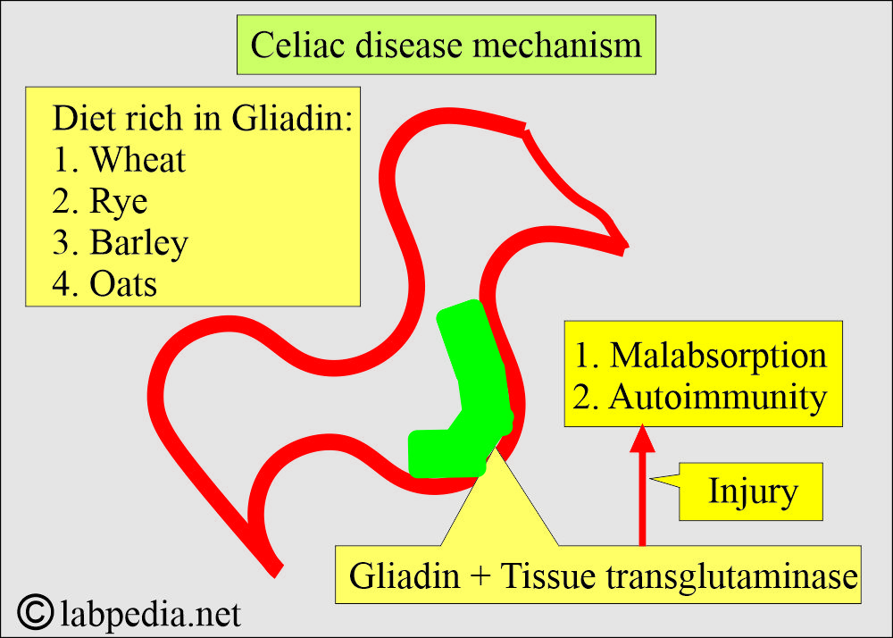 Celiac disease and Sprue: Celiac disease mechanism Celiac disease and Sprue: Celiac disease mechanism