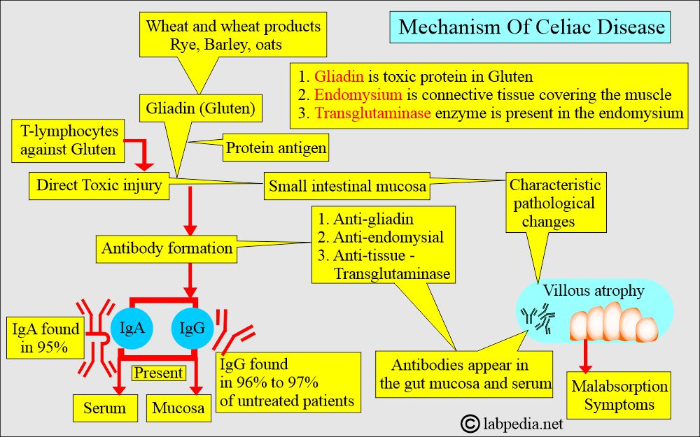 Celiac disease and Sprue: Celiac disease mechanism Celiac disease and Sprue: Celiac disease mechanism