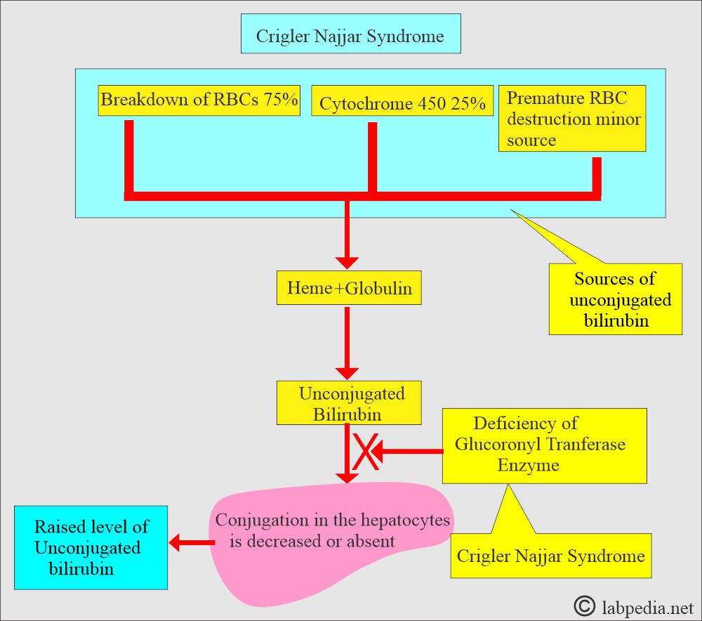 Crigler-Najjar syndrome